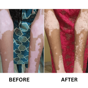 Vitiligo-Treatment-4-300x300