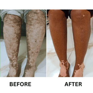 Vitiligo-Treatment-5-300x300