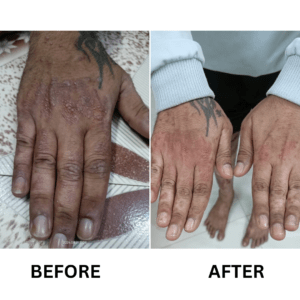 Vitiligo-Treatment-6-300x300